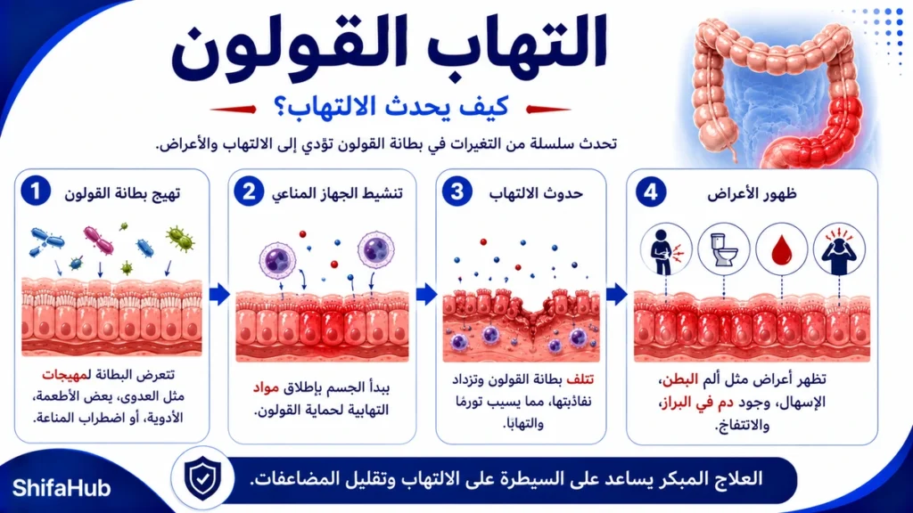 كيف يحدث التهاب القولون؟