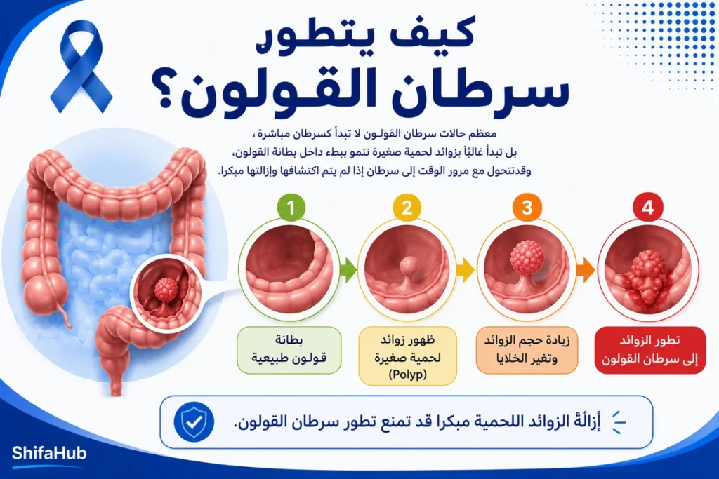 كيف يتطور سرطان القولون؟