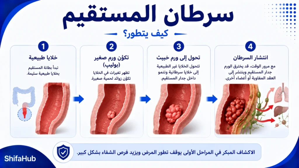 كيف يتطور سرطان المستقيم؟